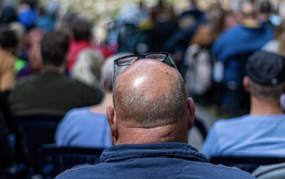 Greffe des cheveux : les implants vont-ils retomber ?