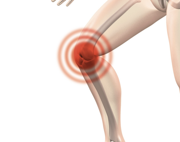 L'arthrose du genou